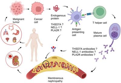 Specific antigens in malignancy-associated membranous nephropathy